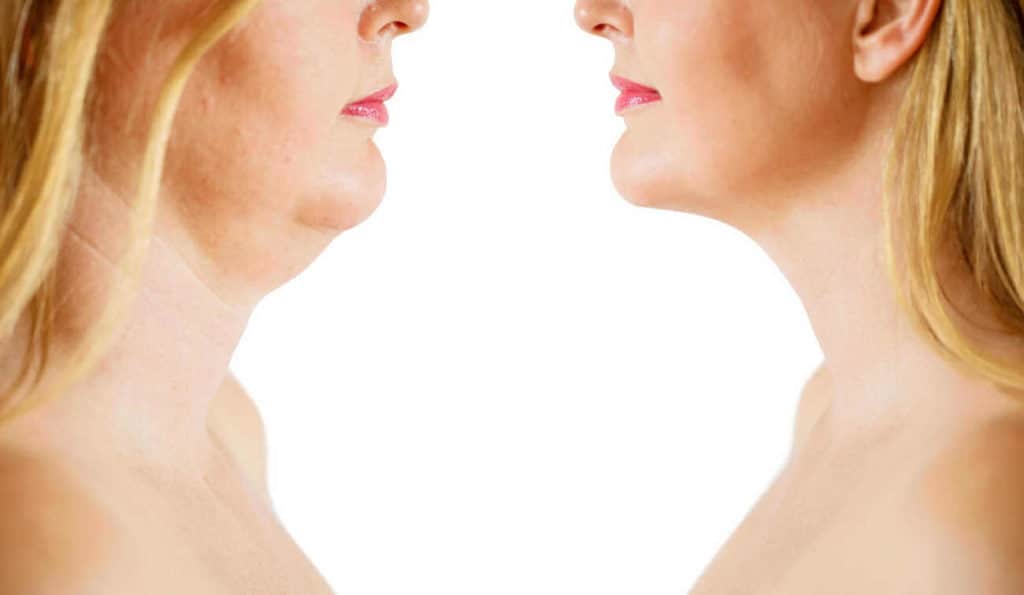 Double Chin treatment Bradford-on-Avon before and after results