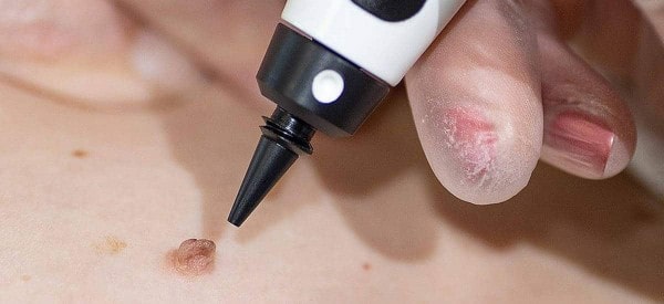 After Skin Tag Removal Bradford-on-Avon