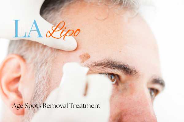 What Are the Most Effective Treatments for Age Spots Bradford-on-Avon?