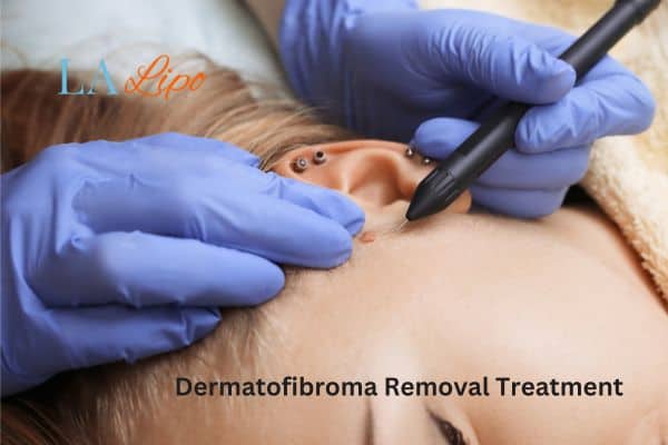 Dermatofibroma Removal Treatment Bradford-on-Avon