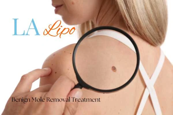 Woman having her inspection of blemish before mole removal Bradford-on-Avon