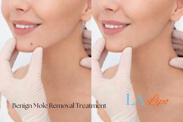Before and after mole removal Bradford-on-Avon treatment