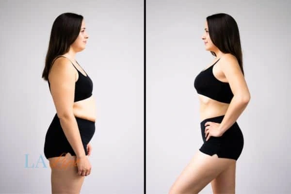 image of woman before and after results of LA-EMS Body Sculpting Bradford-on-Avon to help treat Diastasis recti