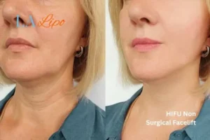 hi-fu for wrinkles Bradford-on-Avon before and after results