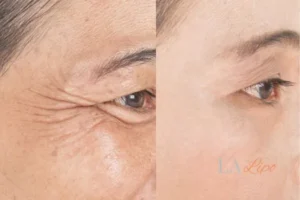 Before and after results of woman - HI-fu wrinkles reduction treatment Bradford-on-Avon
