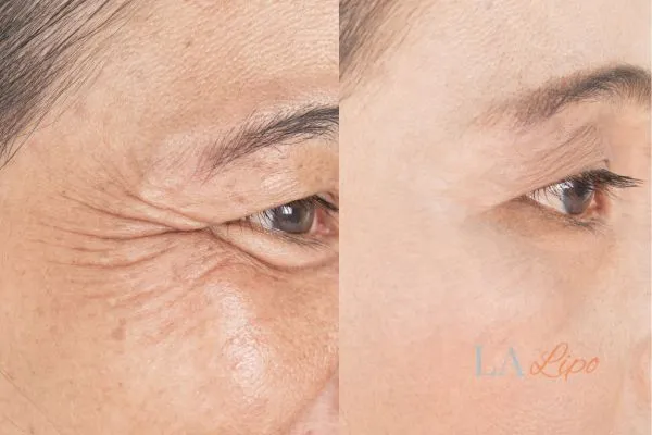 Before and after results of woman - HI-fu wrinkles reduction treatment Bradford-on-Avon