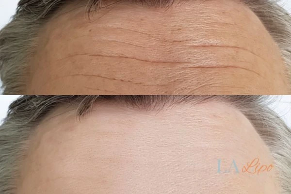 results of HIFU Bradford-on-Avon on mans forehead to help reduce lines and wrinkles