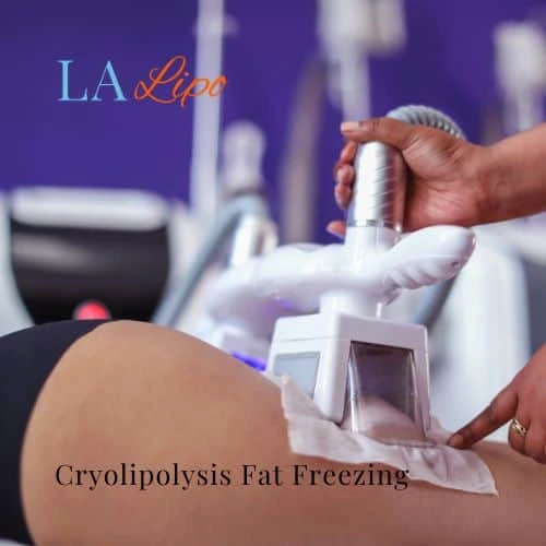 fat freezing - Cryolipolysis Bradford-on-Avon