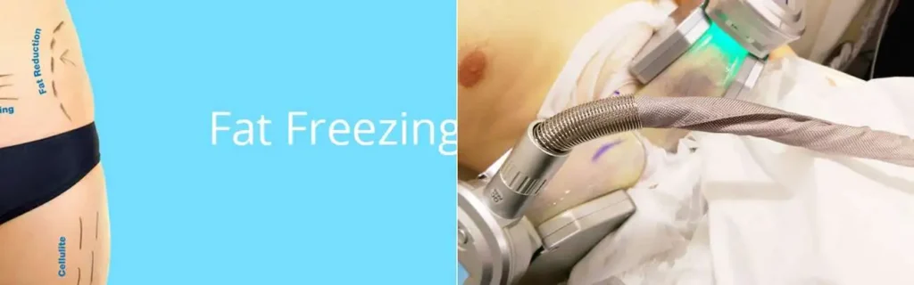 Fat freezing Bradford-on-Avon on multiple areas of the body
