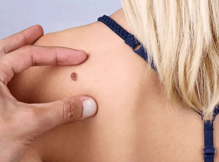 woman having mole removal Bradford-on-Avon consultation before treatment.