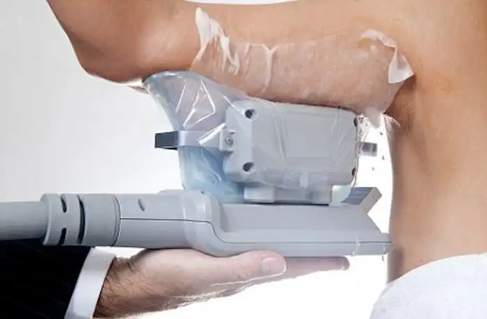 Picture of fat freezing Bradford-on-Avon on the upper arms.
