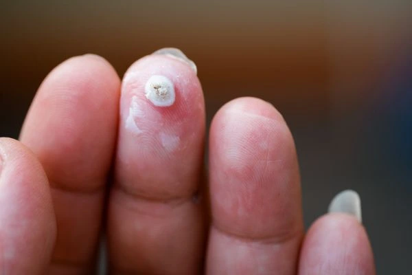 wart on person finger - cryotherapy to treat from LA LIPO Bradford-on-Avon