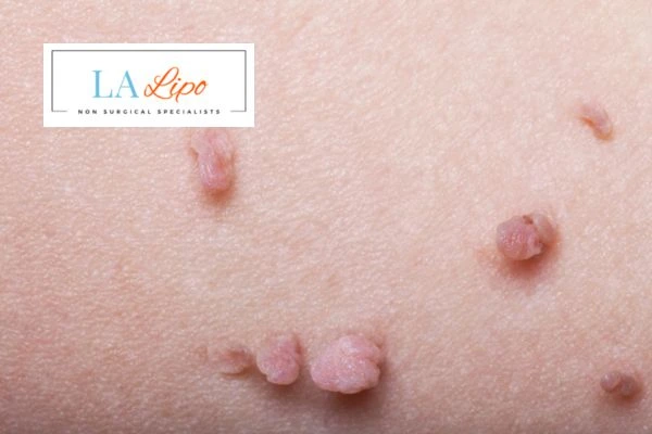 Does cryopen skin tag removal Bradford-on-Avon hurt? Find out now call our team today!