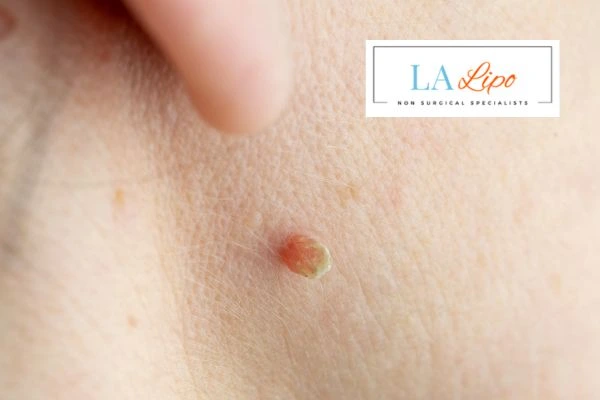 Book skin tag removal Bradford-on-Avon today speak to our team now!