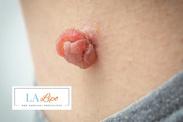 Interested in skin tag removal Bradford-on-Avon? Concerned about the pain? Find out more today!