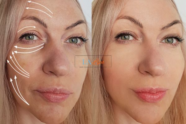Morpheus 8 results Bradford-on-Avon face lift.