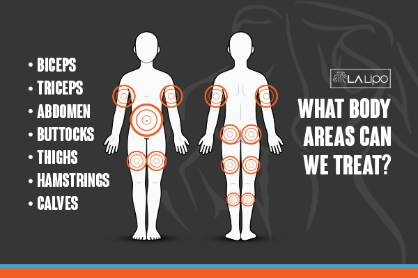 Diagram to show areas you can have LA-EMS Body Sculpting Treatment Bradford-on-Avon