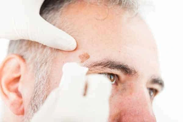 Age spots and elderly people Bradford-on-Avon what is the link?