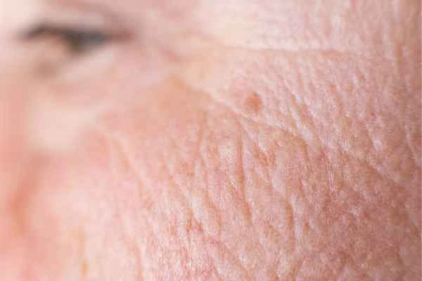 close up picture of a woman's face showing an age spot Bradford-on-Avon