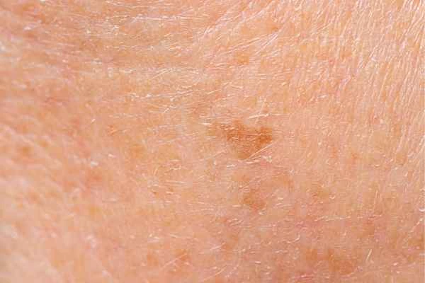 close up picture of age spots Bradford-on-Avon