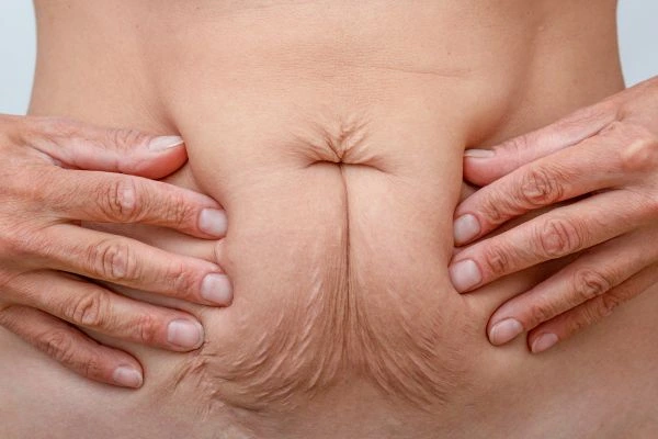 Image of a woman's stomach with loose skin - example of skin tightening Bradford-on-Avon options