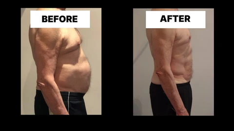 What Symptoms Can Diastasis Recti Cause in Men? Weak Core, Back Pain and Poor Posture Bradford-on-Avon